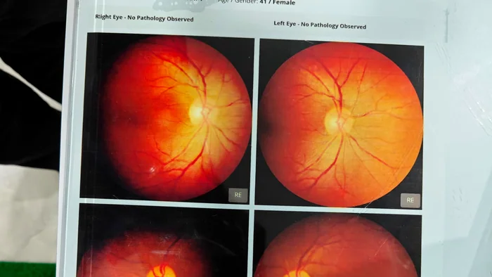 Retina Imaging & Diabetic Eye Screening Karaikal β Actual Fundus Screening Report at Dr. Reddy's