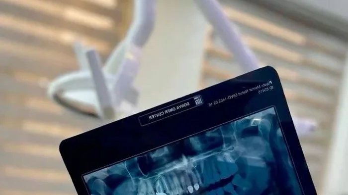 Root Canal Treatment Karaikal β OPG X-Ray Guided Endodontics at Dr. Reddy's Dental